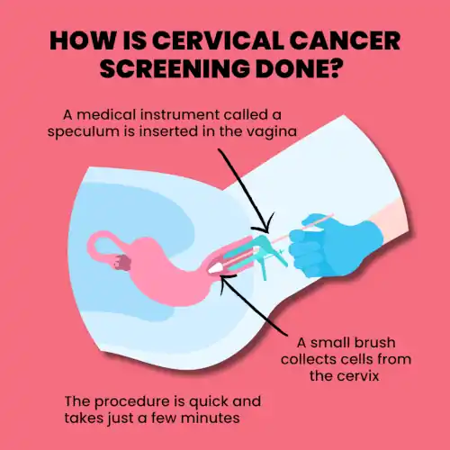poster on how cervical screening is done
