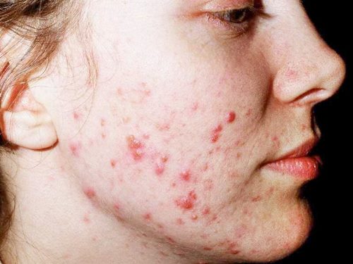 young woman’s face seen from the side with acne on her cheeks, jaw, side of face