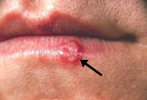 Cold sore caused by oral herpes on a man’s lip